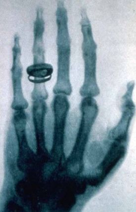 First x-ray